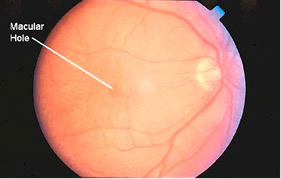 Vitreoretinal Surgery/Image of macular hole. Courtesy of North Shore Eye Centre (www.northshoreeye.com.au)